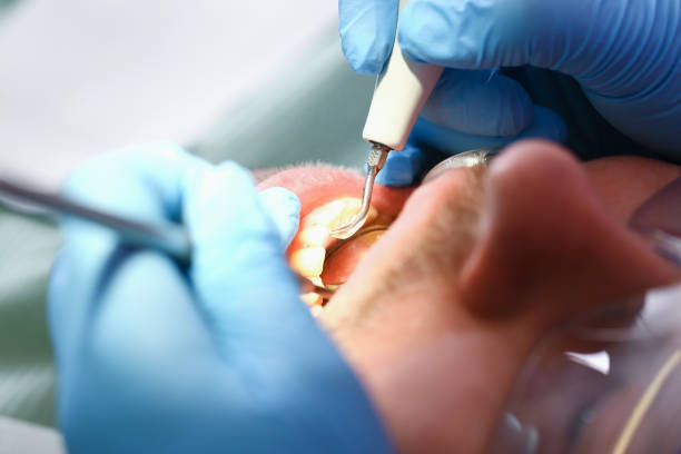Best Emergency Treatment for Dental Infections or Abscesses in Brooklyn Park, MD