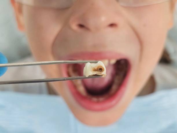 Best Emergency Tooth Extraction in Brooklyn Park, MD